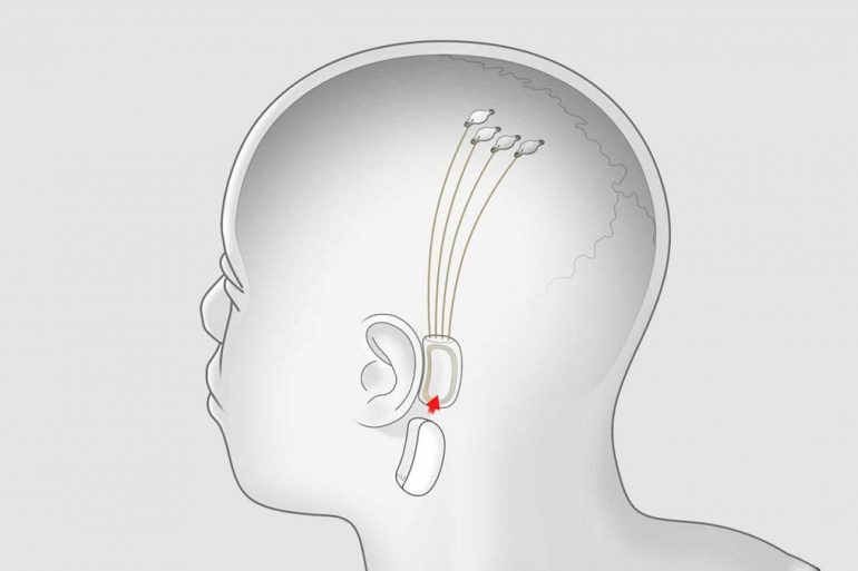 Илон Маск: Neuralink способен транслировать музыку в мозг