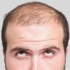 Вчені виявили основну причину втрати волосся у чоловіків